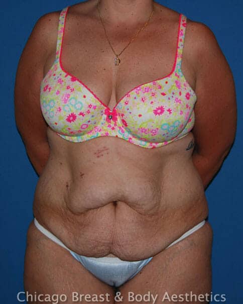 plus size full tummy tuck before after by Dr Truong Chicago Breast & Body Aesthetics 95
