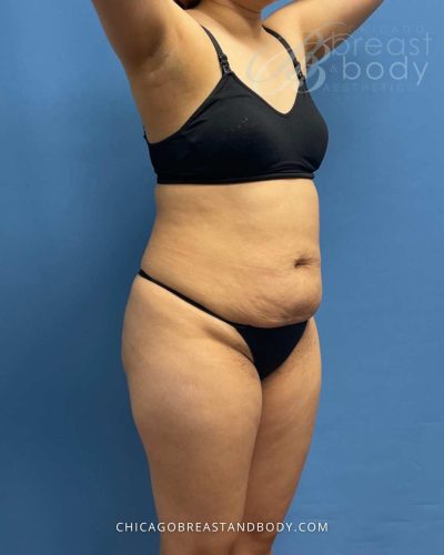 Tummy tuck before photo, case 1745000, actual patient of Dr. Anh-Tuan Truong in Chicago