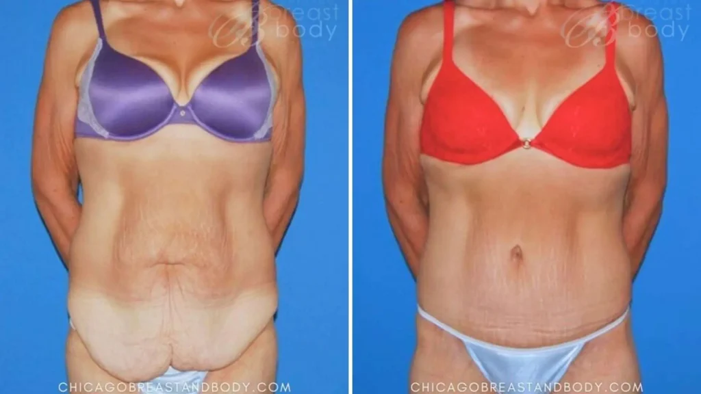 3 Extended Tummy Tuck Before After By Dr. Anh Tuan Truong | Chicago Breast And Body Aesthetics