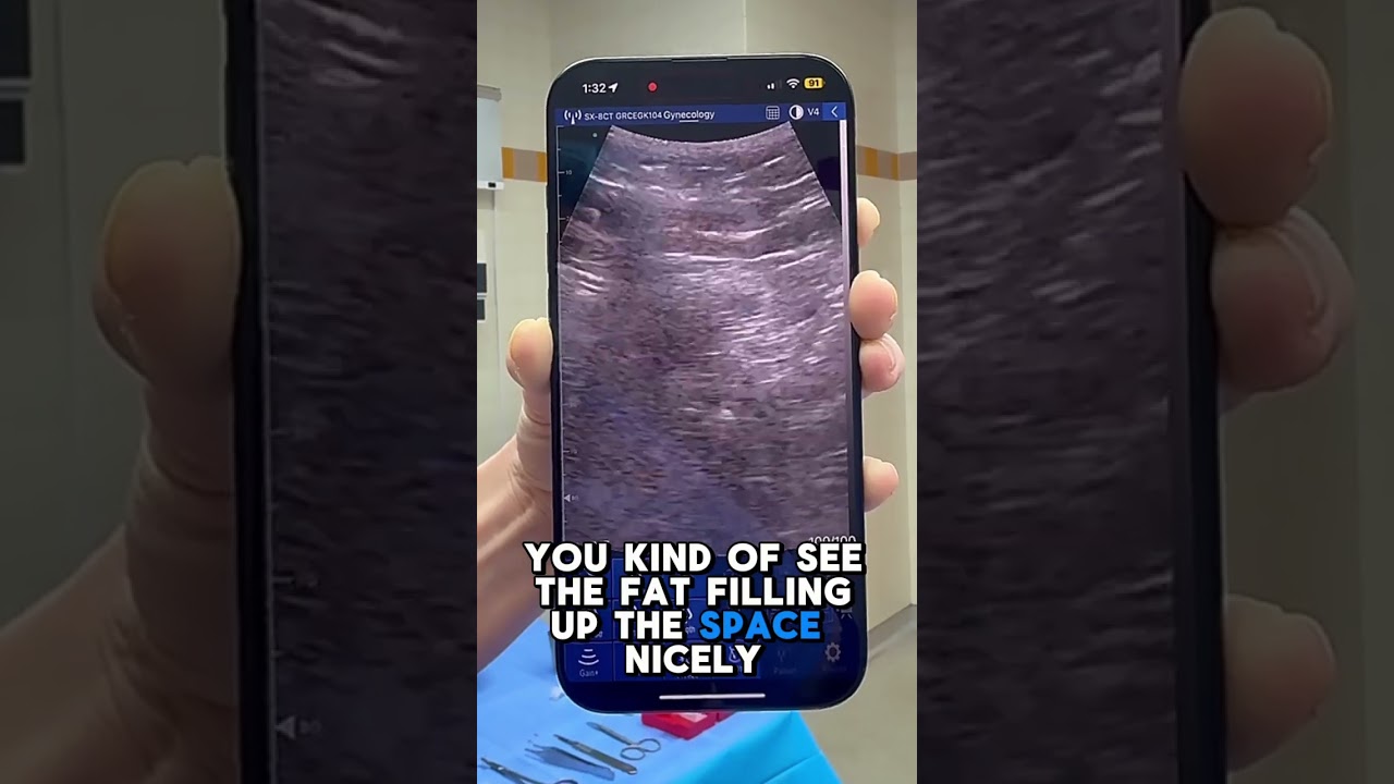 Ultrasound screen showing fat being placed during an ultrasound-guided BBL, video thumbnail