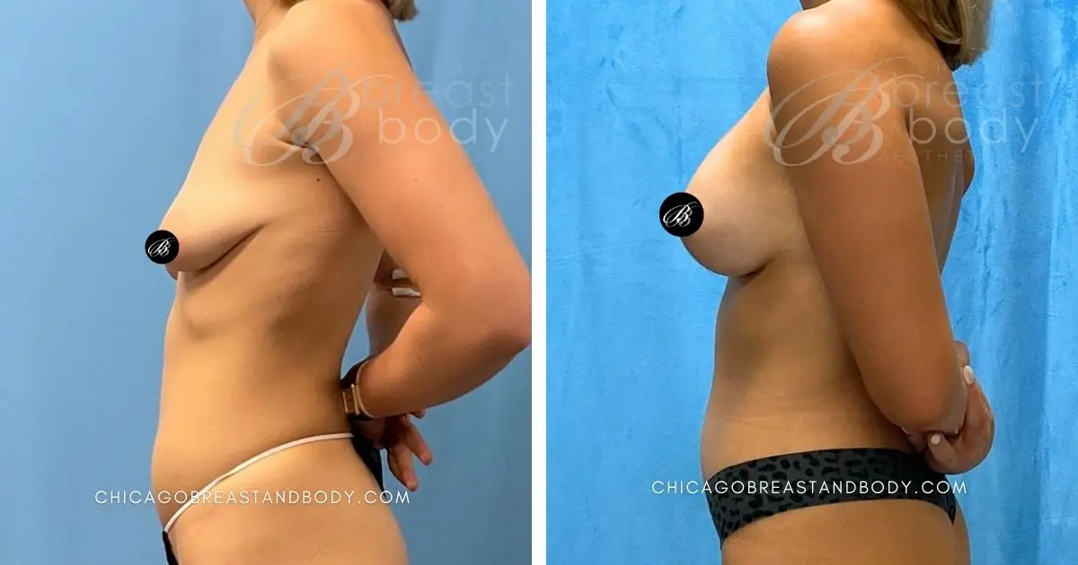 2007179 Breast Implant With Lift By Dr. Kevin Lin Chicago