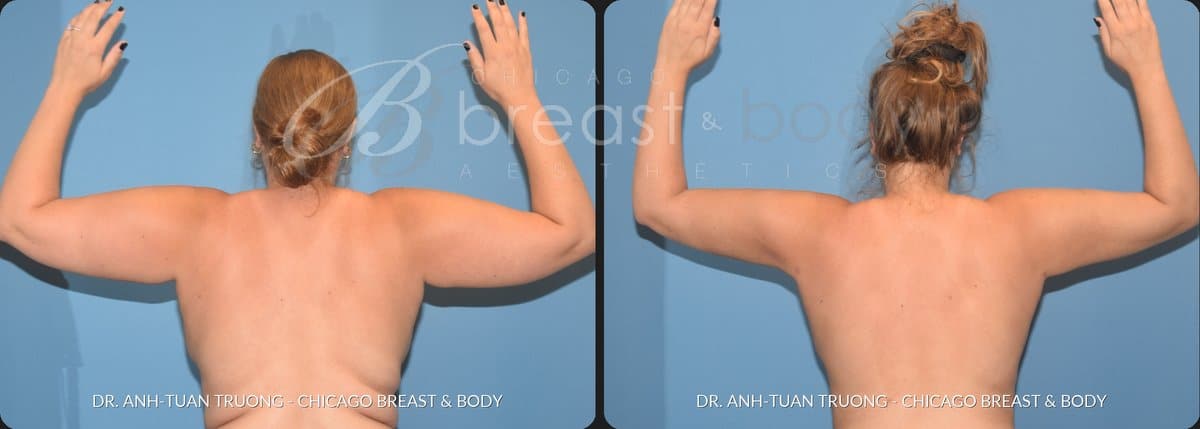 Before and after arm liposuction with Renuvion by Dr. Truong Chicago Breast and Body