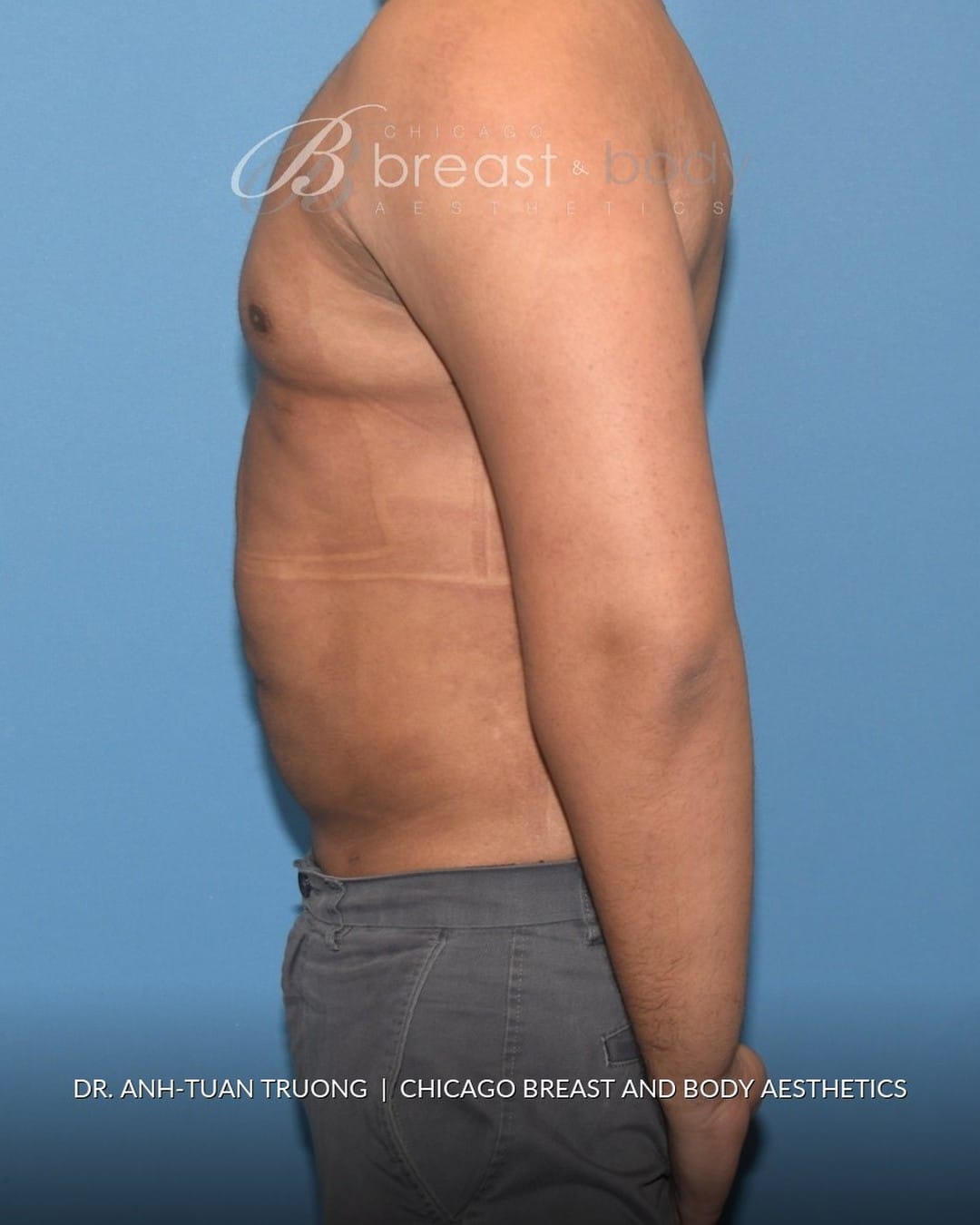 After photo of the same male Lipo 360 patient of Dr. Anh-Tuan Truong at 1 month, side view with a flat abdomen