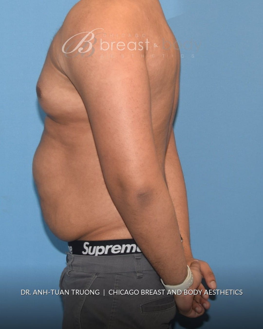 Before photo of a male Lipo 360 patient of Dr. Anh-Tuan Truong at Chicago Breast and Body, side view