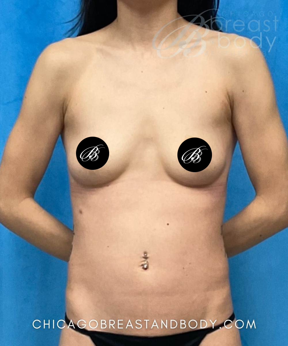 Before breast augmentation with 300cc implants, front view, case 2220564, patient of Dr. Kevin Lin