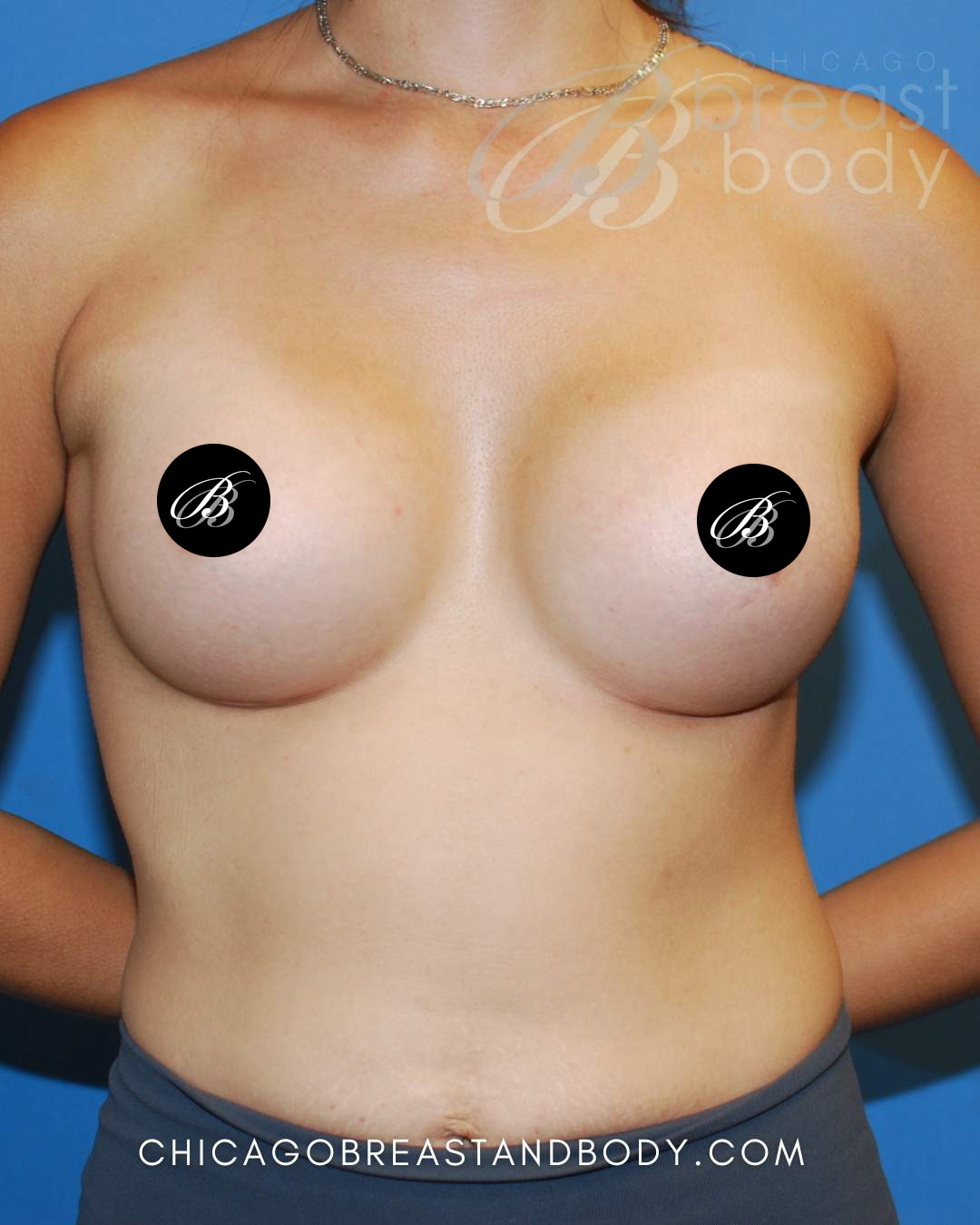 After breast augmentation with 350cc implants, front view, 3 months after surgery, case 1710503, patient of Dr. Anh-Tuan Truong