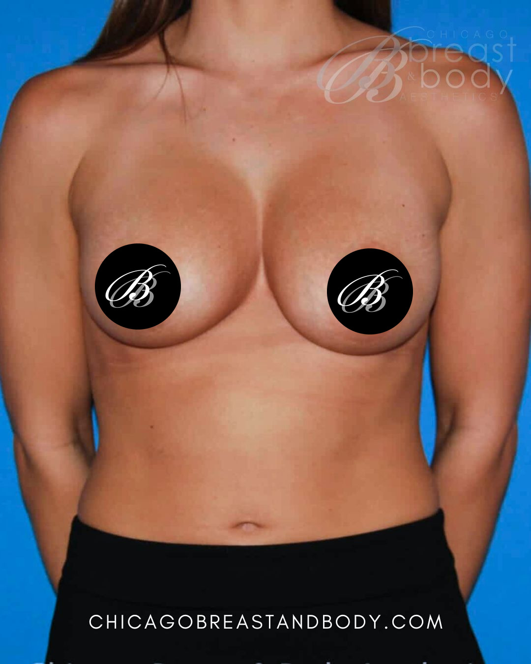 After breast augmentation with 350cc implants, front view, case 218, patient of Dr. Anh-Tuan Truong