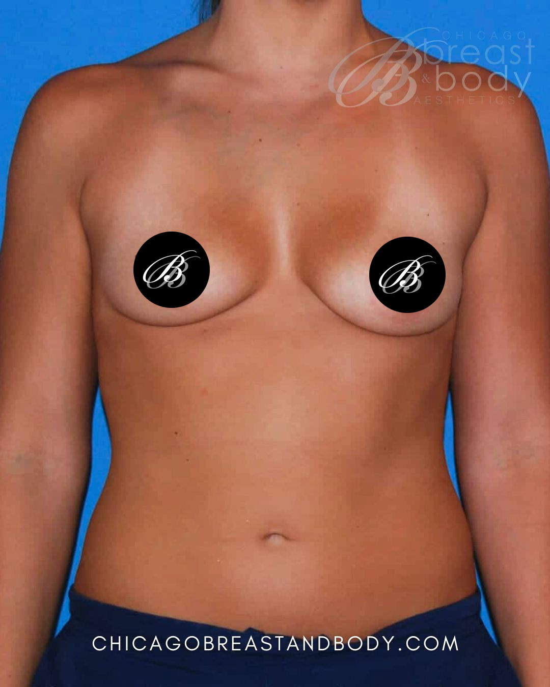 Before breast augmentation with 350cc implants, front view, case 218, patient of Dr. Anh-Tuan Truong