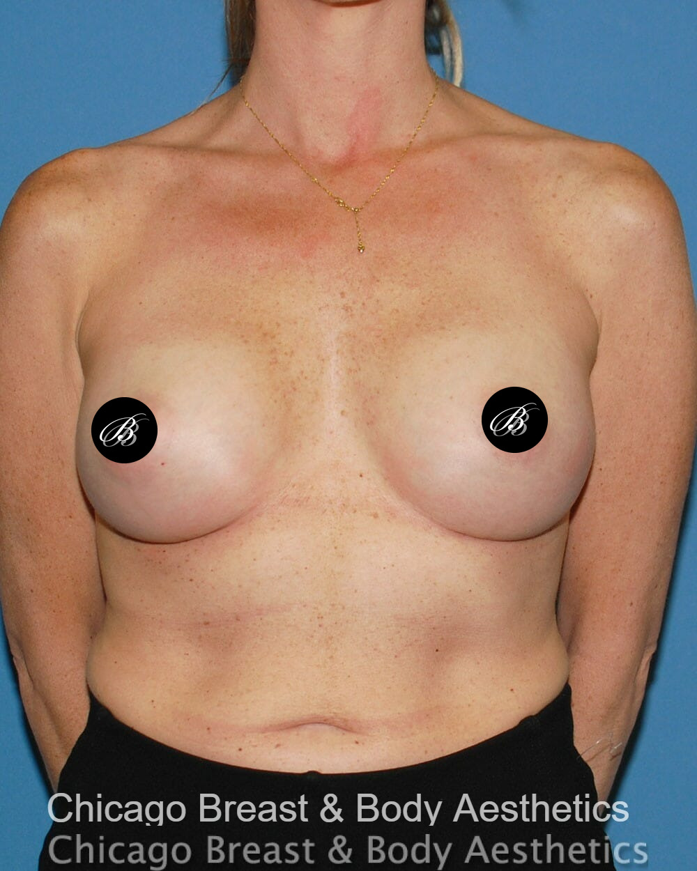 After breast augmentation with 350cc implants, front view, 3 months after surgery, case 32574, patient of Dr. Anh-Tuan Truong