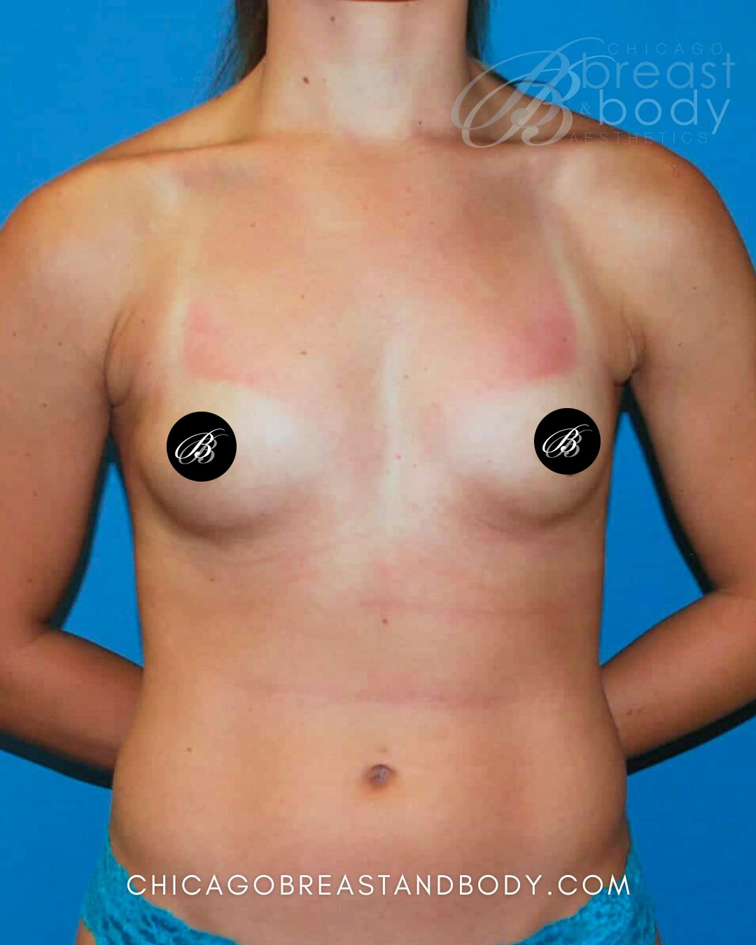 Before breast augmentation with 350cc implants, front view, case 421, patient of Dr. Anh-Tuan Truong