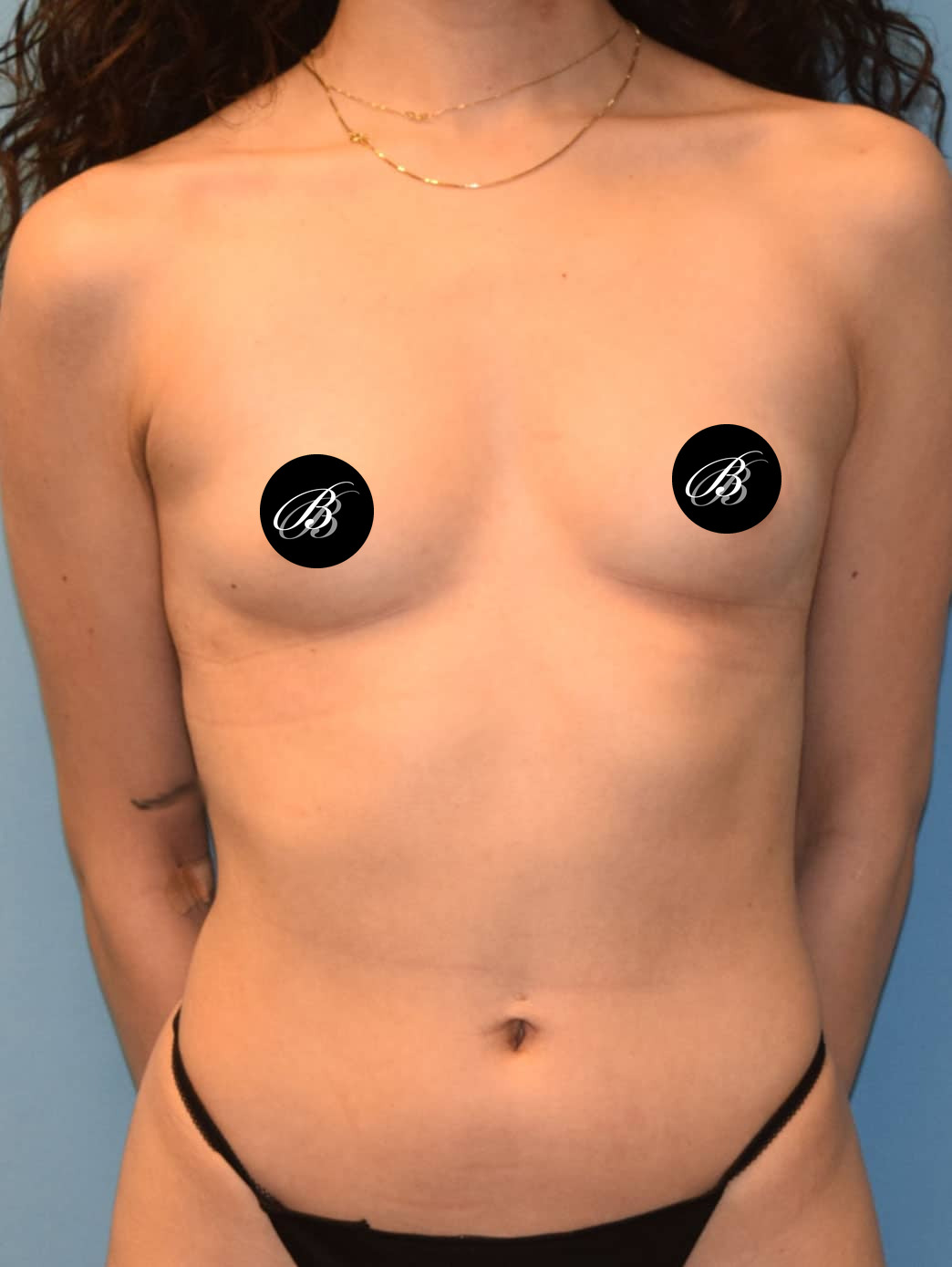 Before breast augmentation with 355cc implants, front view, case 1256, patient of Dr. Kevin Lin