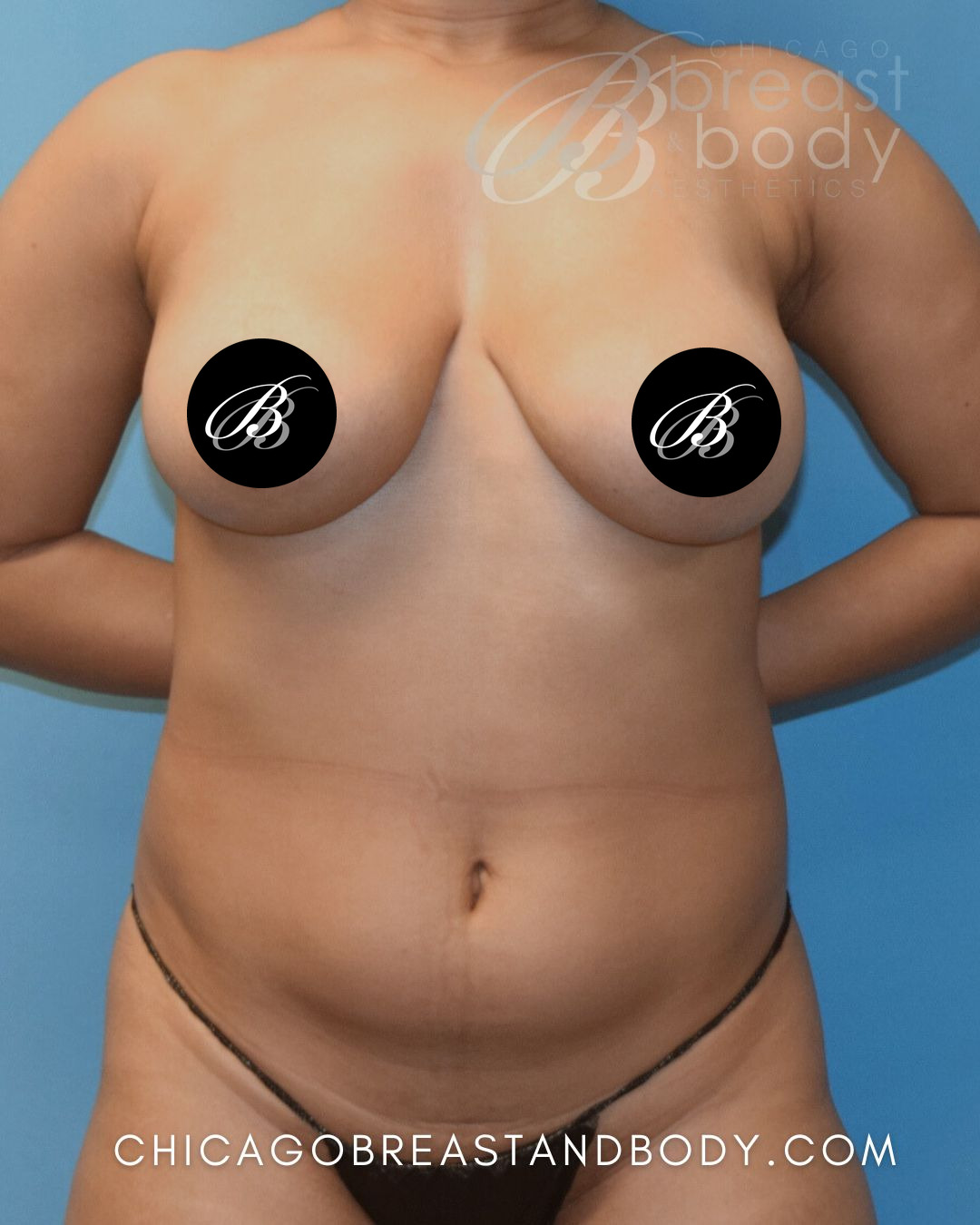 Before breast augmentation with 355cc implants, front view, case 1580172, patient of Dr. Kevin Lin