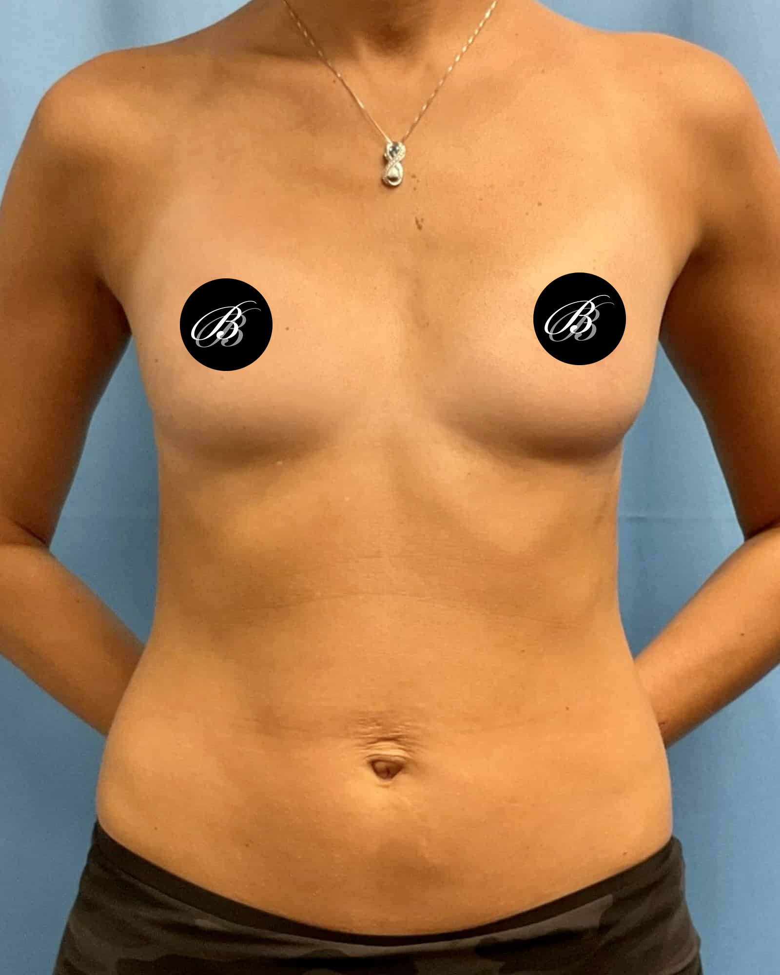 Before breast augmentation with 355cc implants, front view, case 1811228, patient of Dr. Kevin Lin