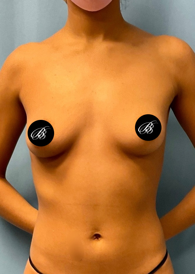 Before breast augmentation with 380cc implants, front view, case 1808453, patient of Dr. Kevin Lin