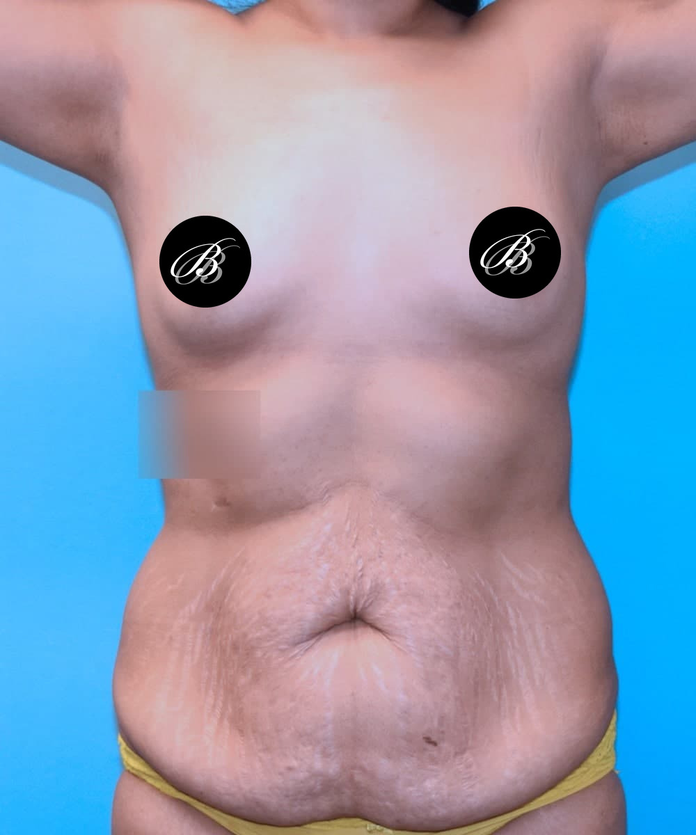 Before breast augmentation with 400cc implants and a tummy tuck, front view, case 1665493, patient of Dr. Kevin Lin