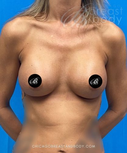 Breast augmentation after photo, case 2047119, actual patient of Dr. Anh-Tuan Truong in Chicago