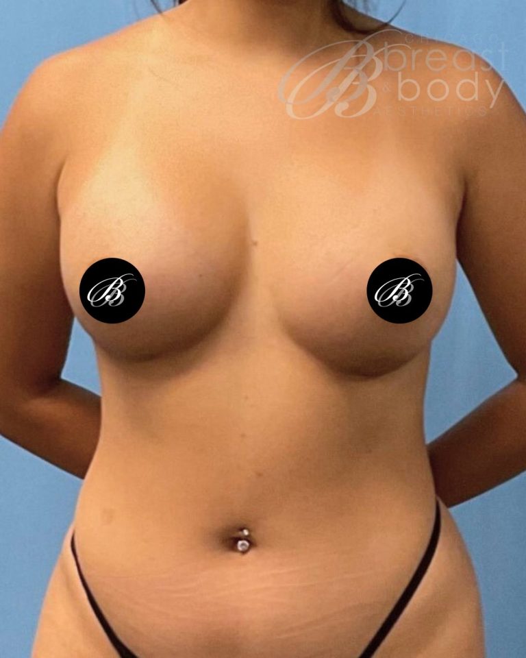 After breast augmentation with 400cc implants, front view, 4 months after surgery, case 1975784, patient of Dr. Kevin Lin