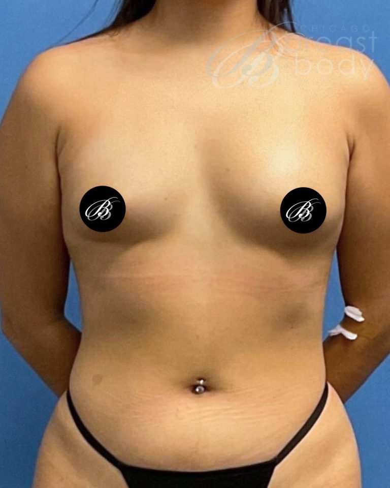 Before breast augmentation with 400cc implants, front view, case 1975784, patient of Dr. Kevin Lin
