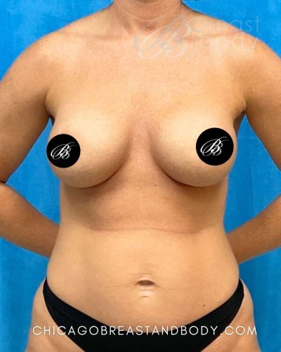 Breast augmentation after photo with 375cc high profile implants, case 2224190, same patient of Dr. Kevin Lin in Chicago