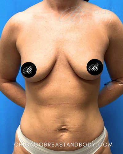 Breast augmentation before photo, case 2224190, patient of Dr. Kevin Lin in Chicago