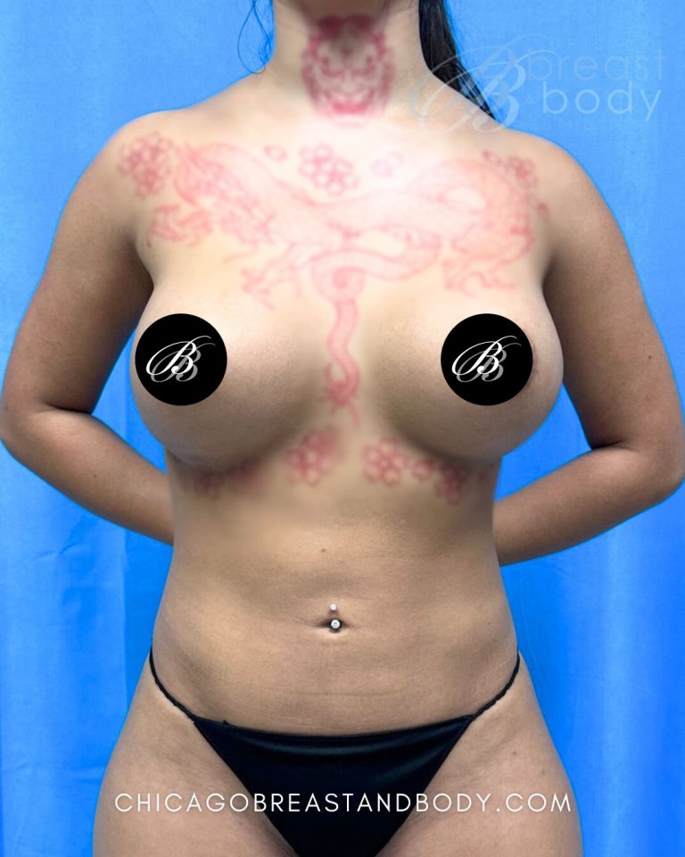 After breast augmentation with 400cc implants, front view, 3 months after surgery, case 1919945, patient of Dr. Anh-Tuan Truong