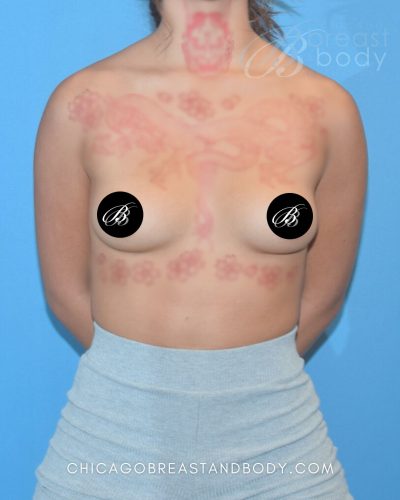 Breast augmentation before photo, case 1919945, patient of Dr. Anh-Tuan Truong in Chicago