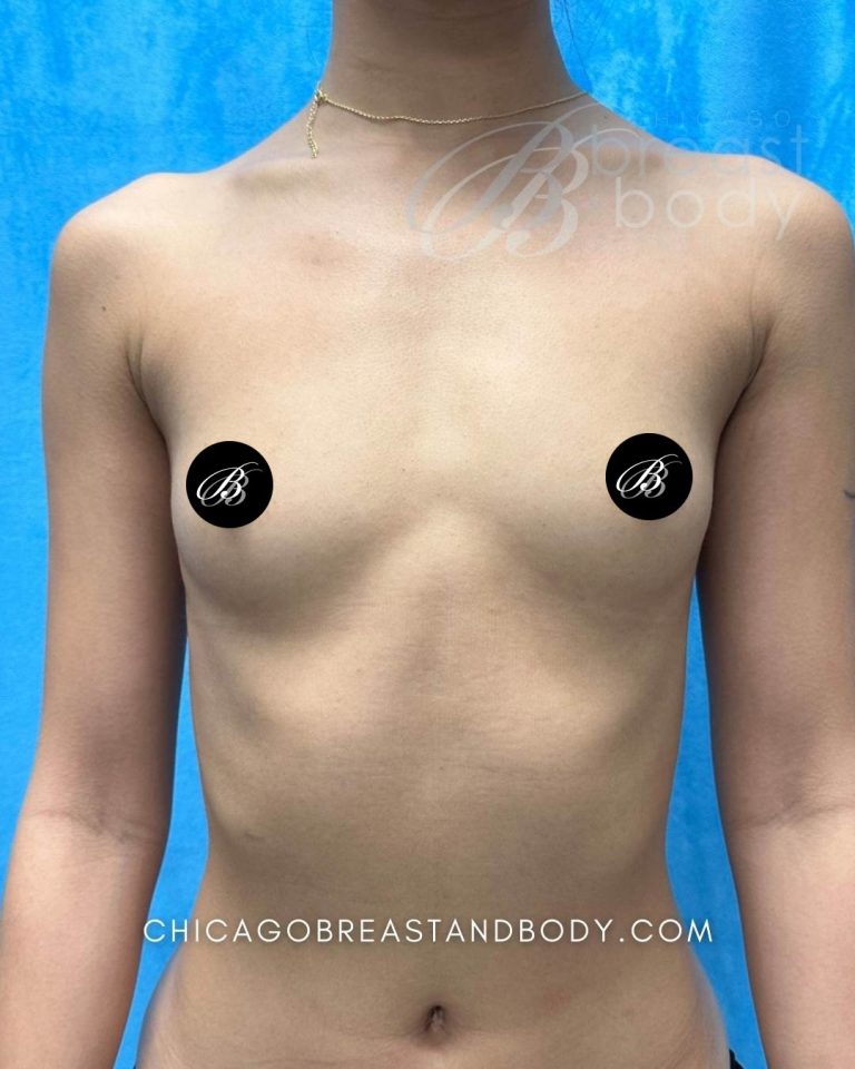 Before breast augmentation photo, case 2346542, patient of Dr. Anh-Tuan Truong, front view