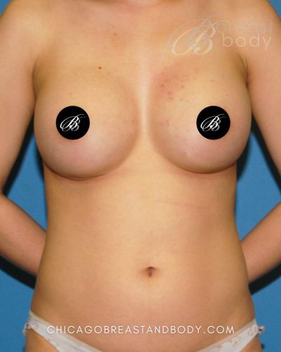 Breast augmentation after photo, case 347, same patient of Dr. Anh-Tuan Truong in Chicago