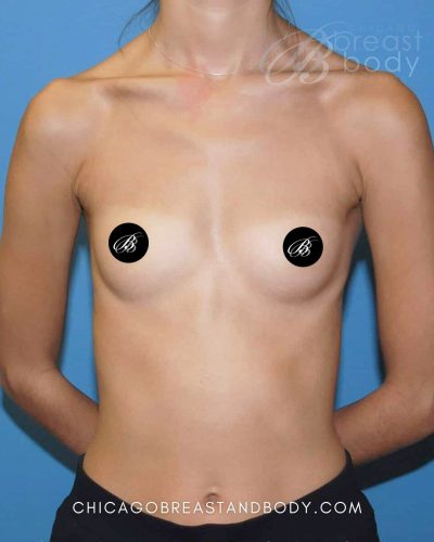 Breast augmentation before photo, case 490, patient of Dr. Anh-Tuan Truong in Chicago