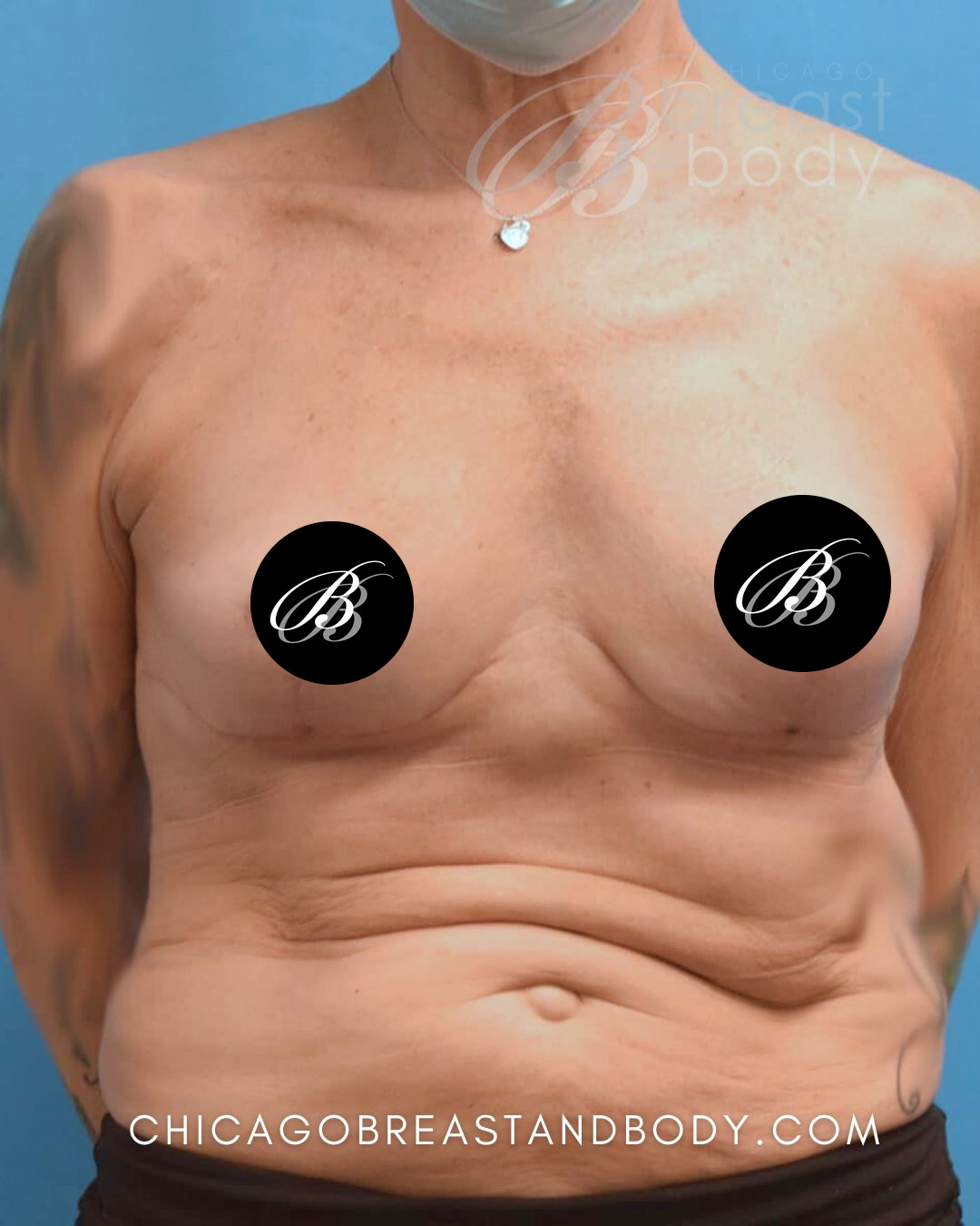 After photo of a breast implant removal patient of Dr. Kevin Lin, case 1668425, front view