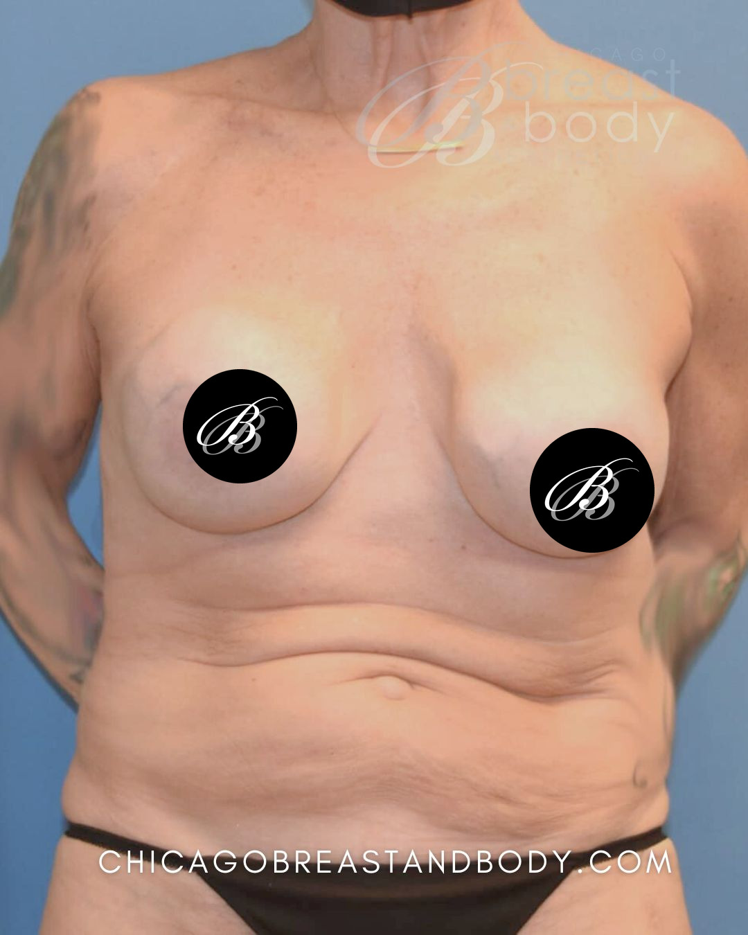 Before photo of a breast implant removal patient of Dr. Kevin Lin, case 1668425, front view