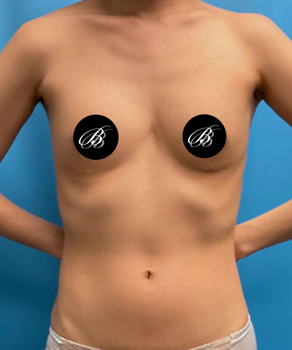 After photo of a breast implant removal patient of Dr. Kevin Lin, case 1742629, front view
