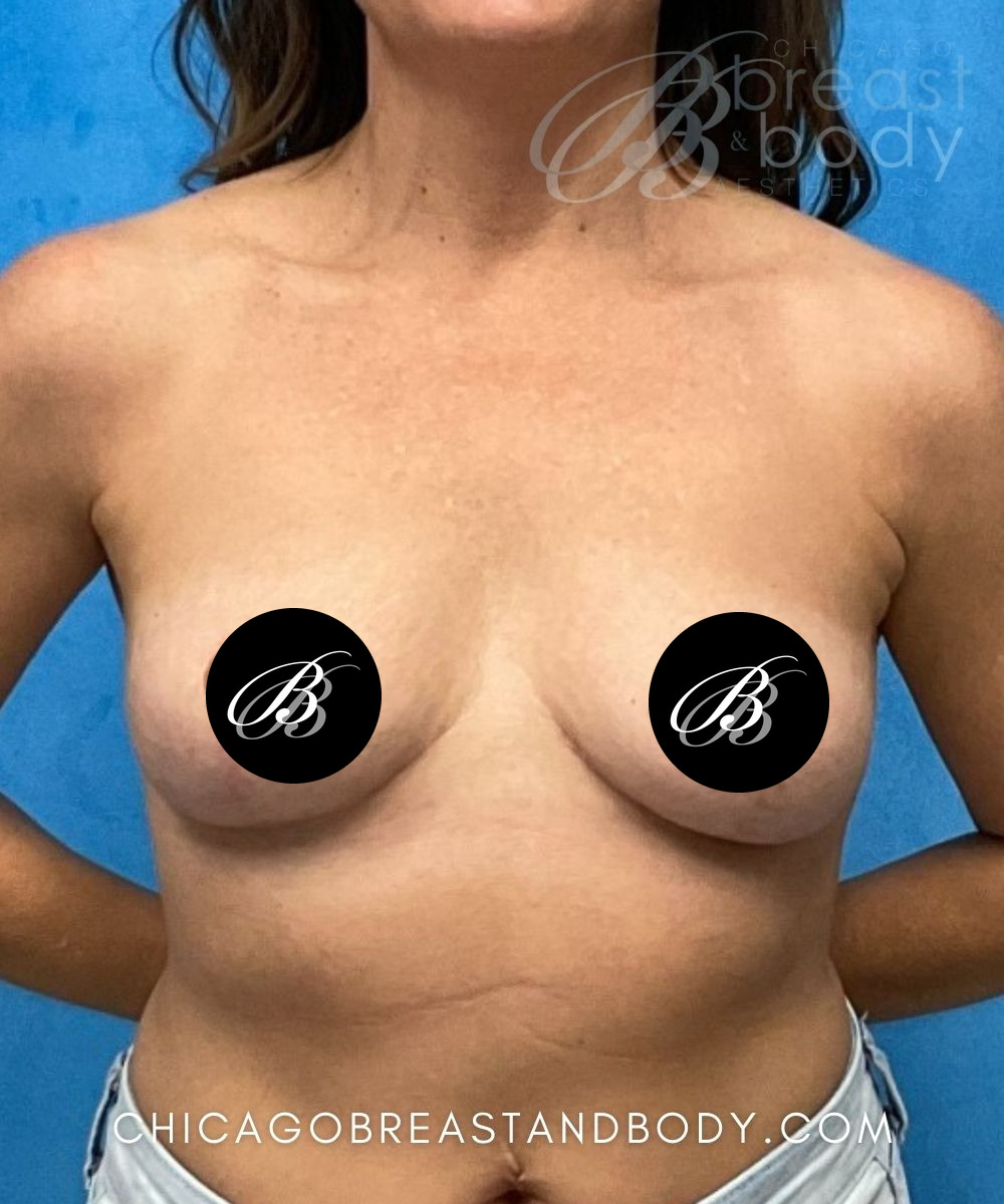 After photo of a breast implant removal patient of Dr. Kevin Lin, case 2028568, front view