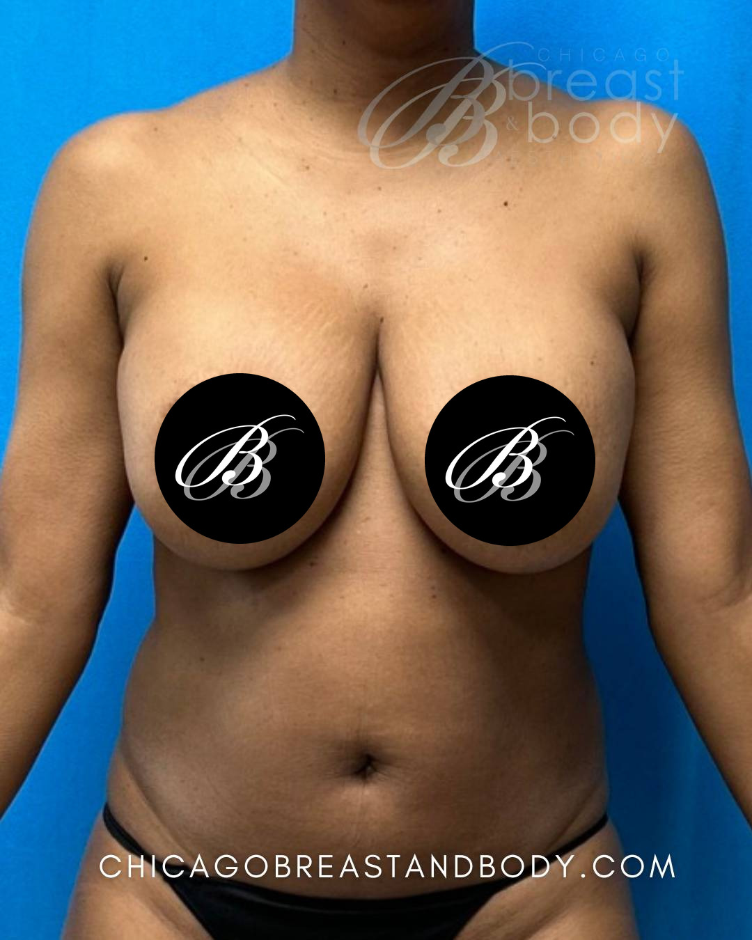 Before breast implant removal photo, case 2315176, patient of Dr. Kevin Lin, front view