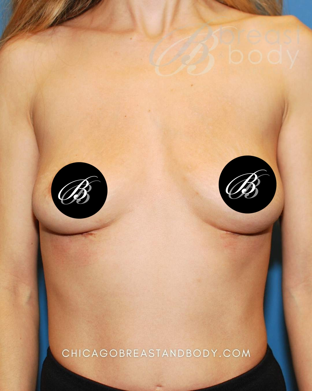 After photo of a breast implant removal patient of Dr. Anh-Tuan Truong, case 1663158, front view