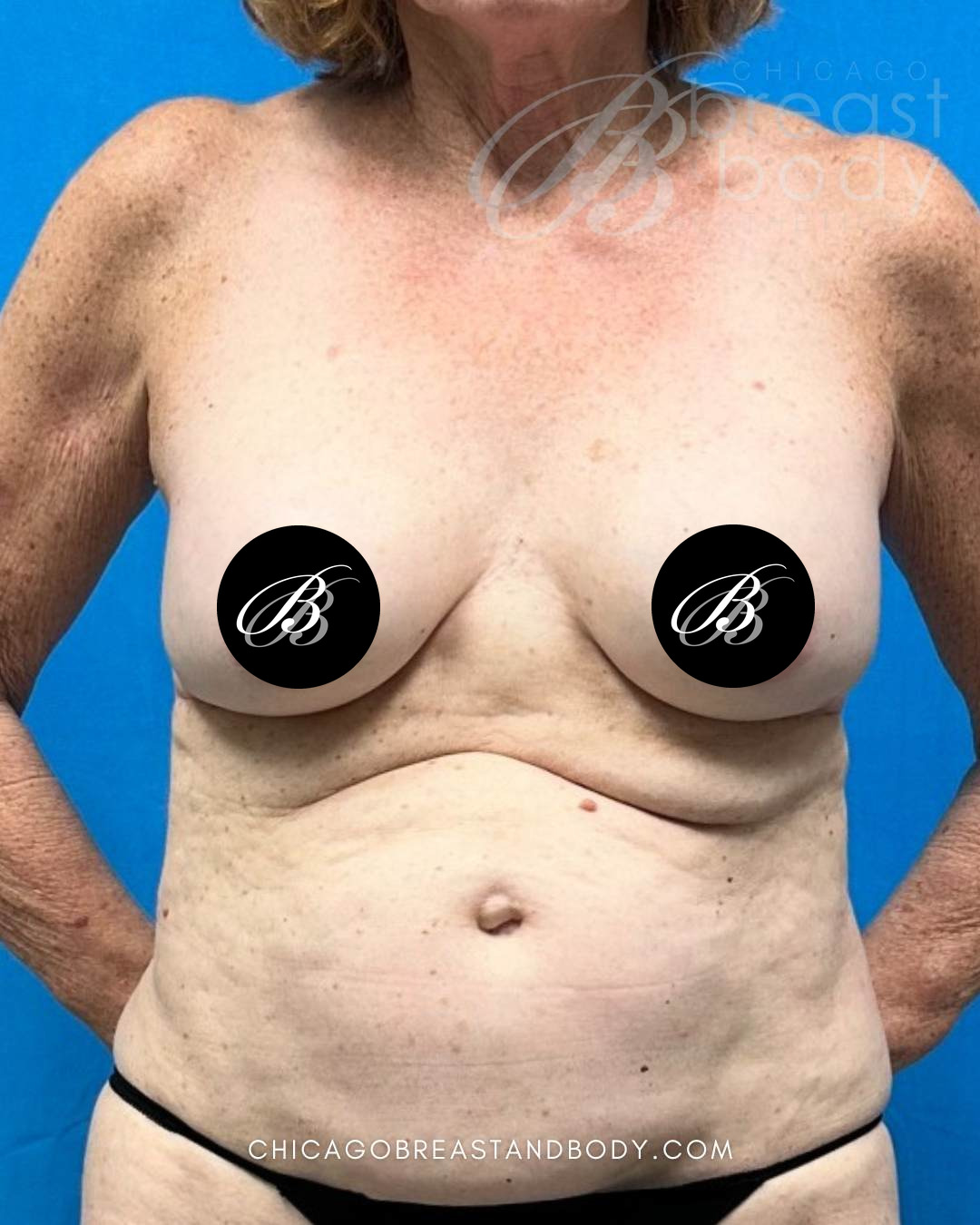 Before photo of a breast implant removal patient of Dr. Anh-Tuan Truong, case 2303599, front view