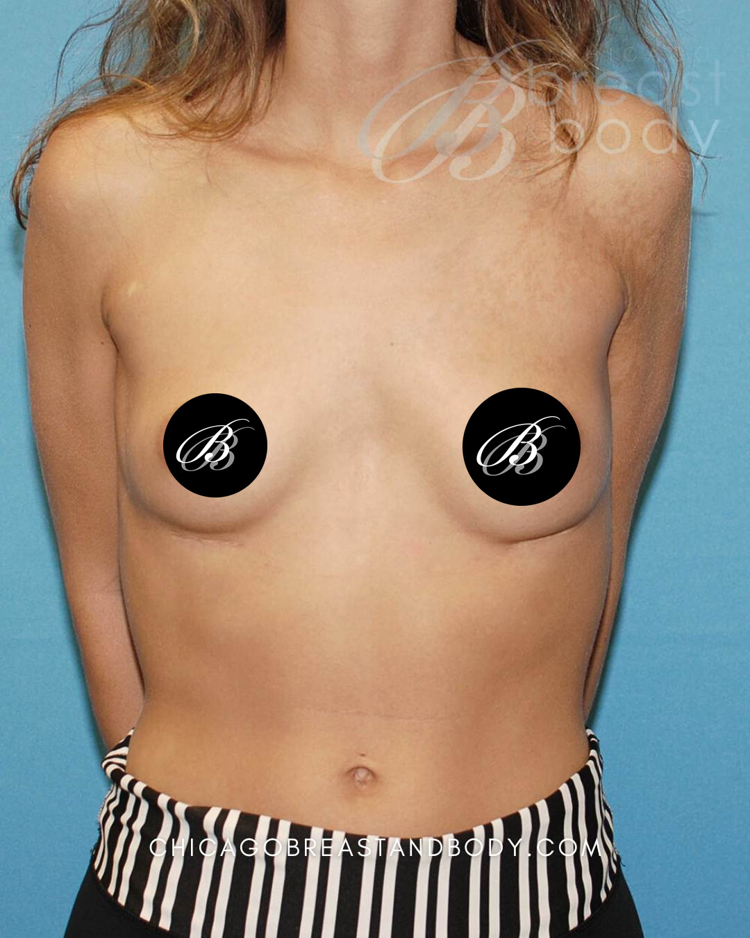 After breast implant removal photo, case 6353, patient of Dr. Anh-Tuan Truong, front view