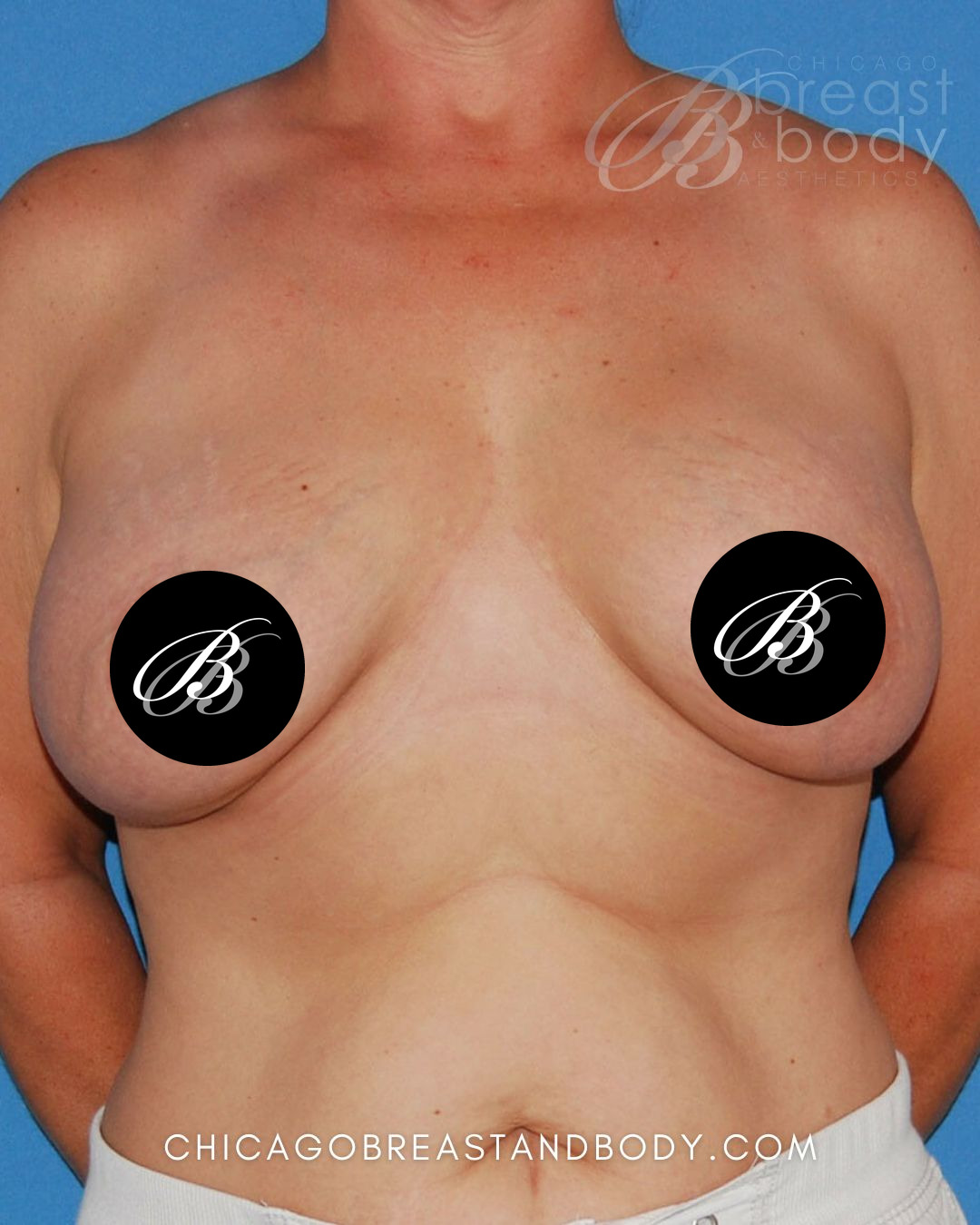 Before photo of a breast implant removal patient of Dr. Anh-Tuan Truong, case 6369, front view