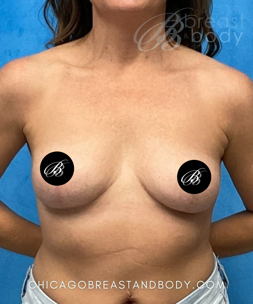 After photo of an implant removal with breast lift patient of Dr. Kevin Lin, case 2028568