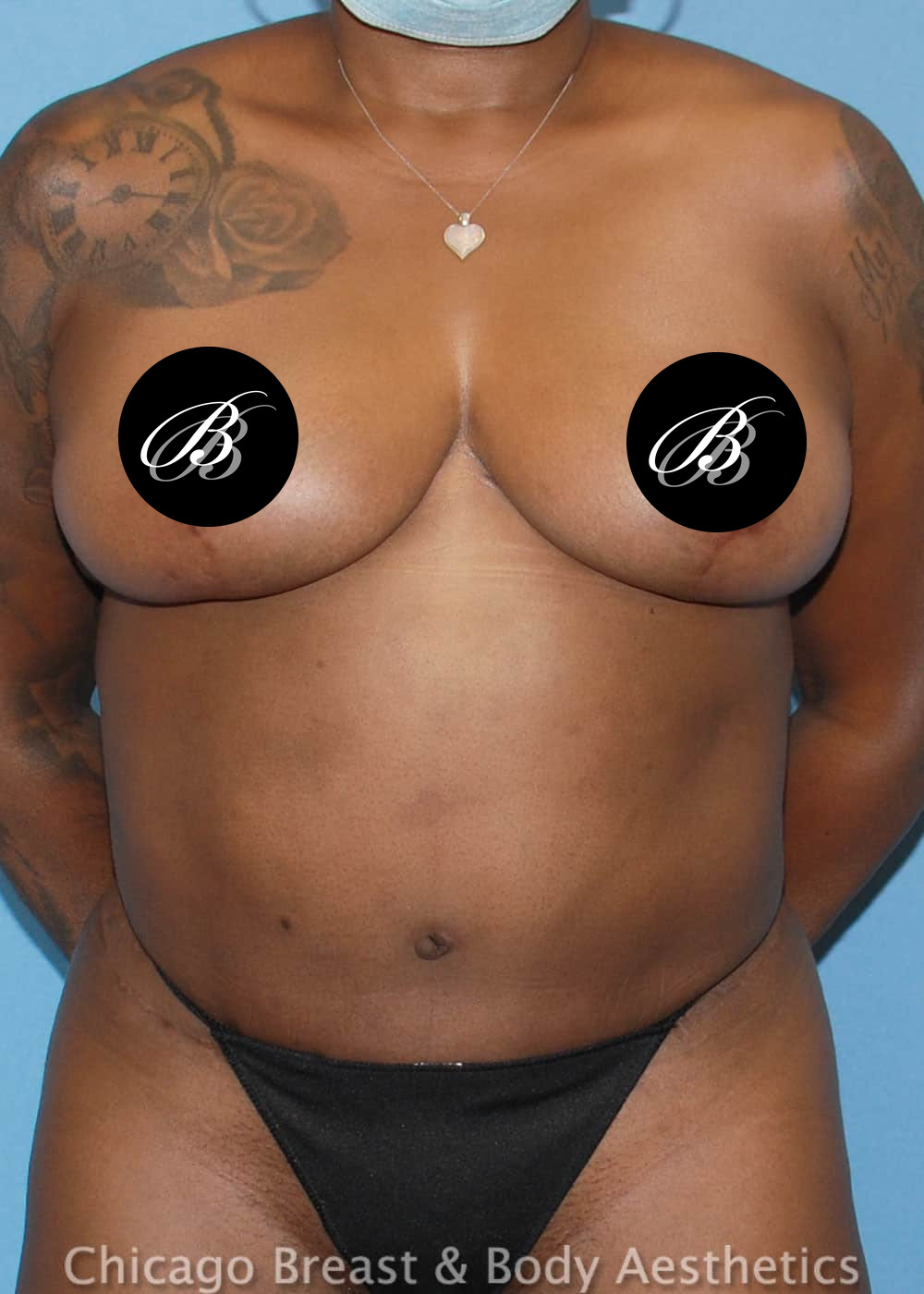 After photo of a breast lift (mastopexy) patient of Dr. Anh-Tuan Truong, case 35547