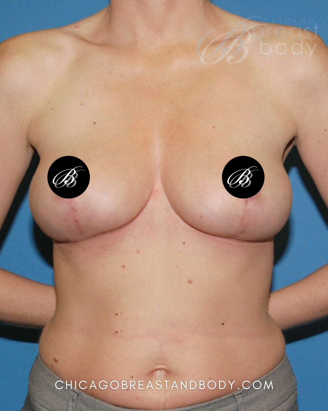 After photo of a breast lift (mastopexy) patient of Dr. Anh-Tuan Truong, case 471
