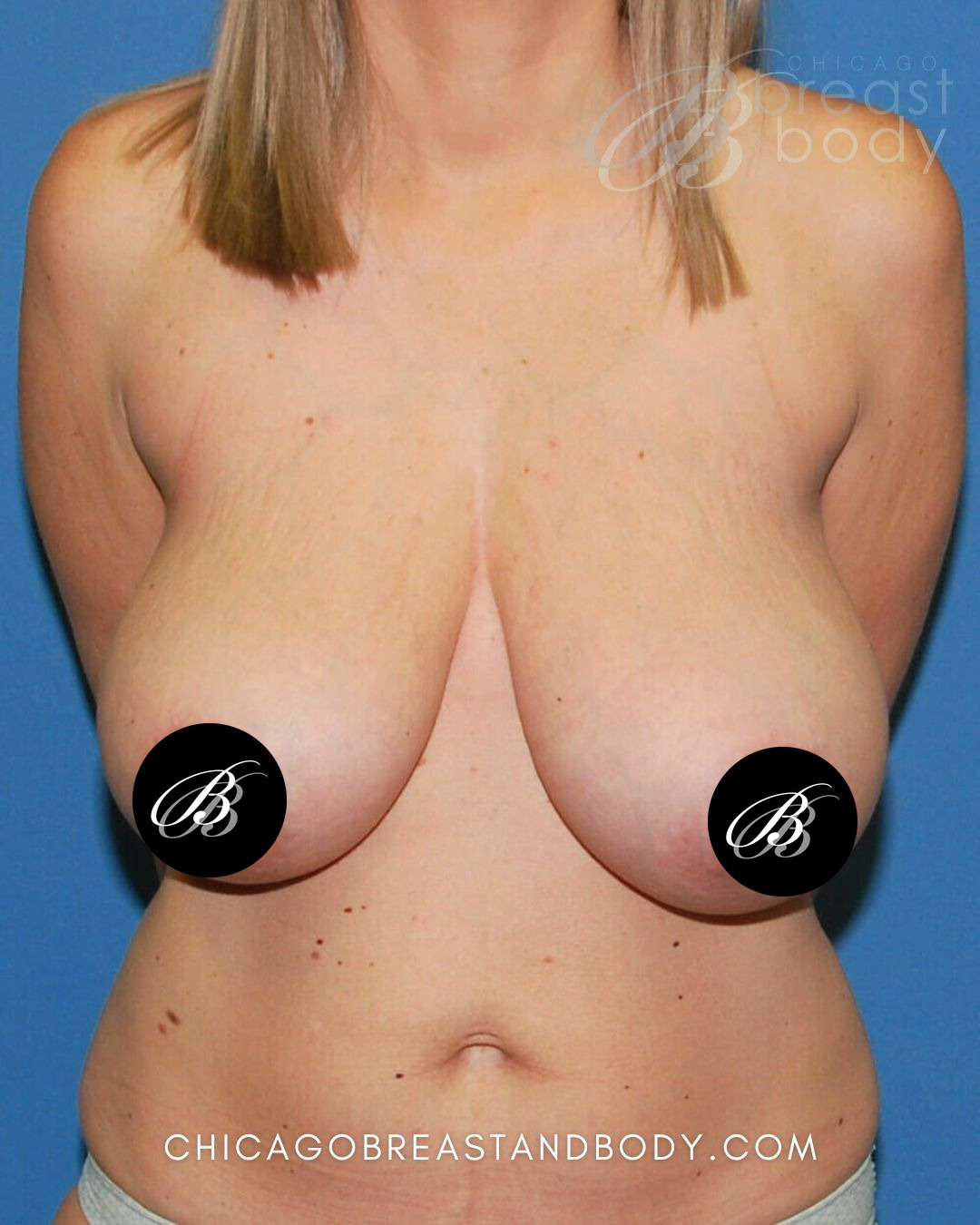 Before photo of a breast lift (mastopexy) patient of Dr. Anh-Tuan Truong, case 471