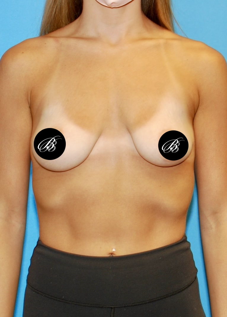 Before breast lift with 350cc implants, front view, case 1555409, patient of Dr. Anh-Tuan Truong