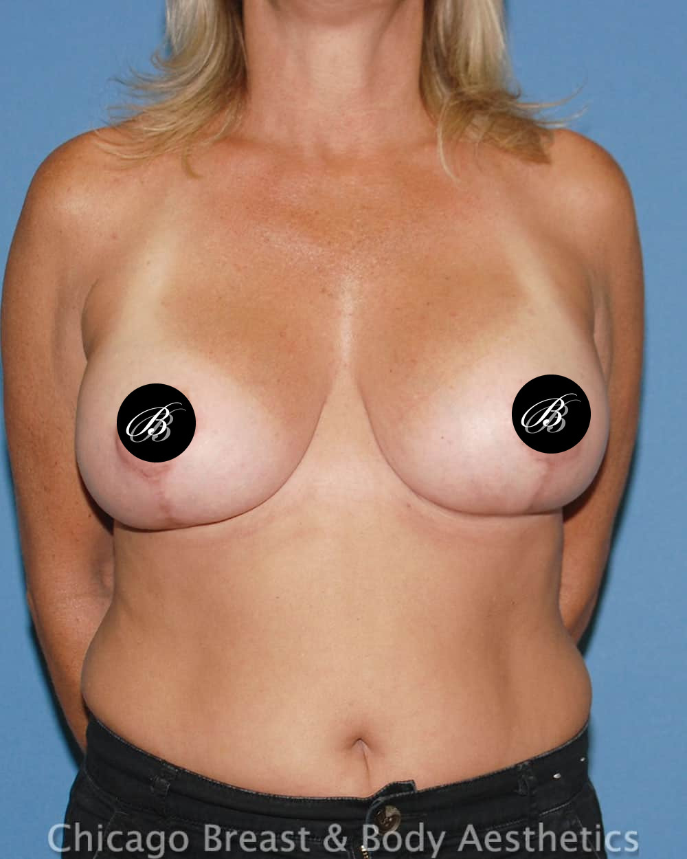 After breast lift with 350cc implants, front view, 3 months after surgery, case 6511, patient of Dr. Anh-Tuan Truong