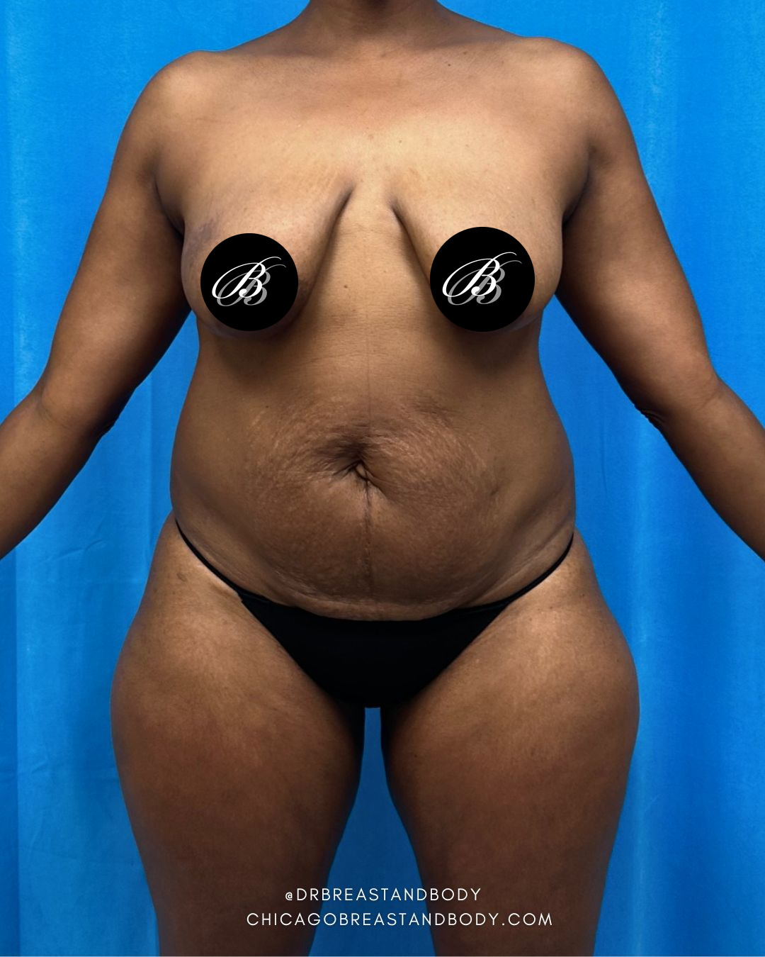 Before breast lift with 400cc implants, front view, case 2294674, patient of Dr. Anh-Tuan Truong