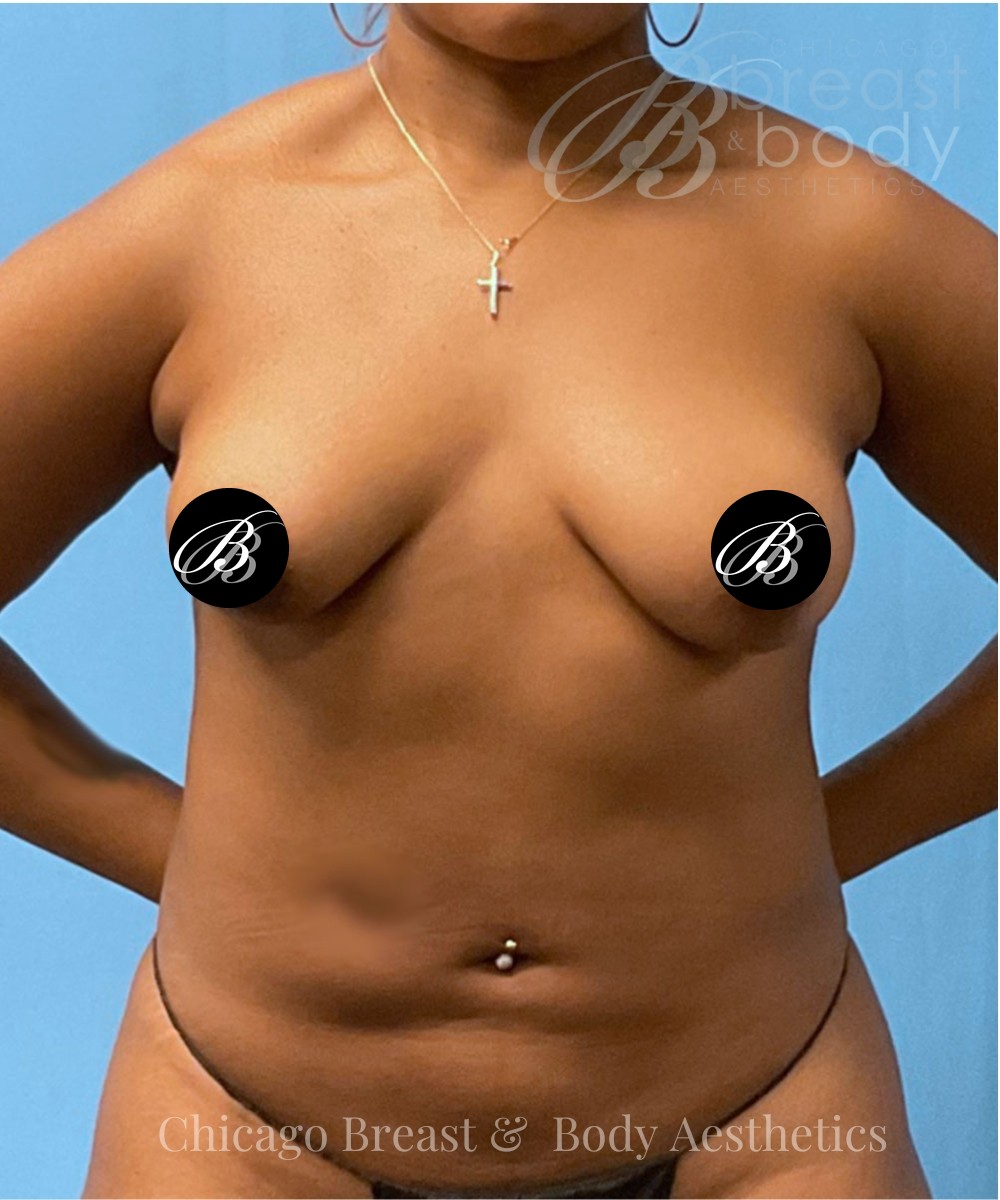 Before breast lift with 350cc implants, front view, case 1687766, patient of Dr. Kevin Lin