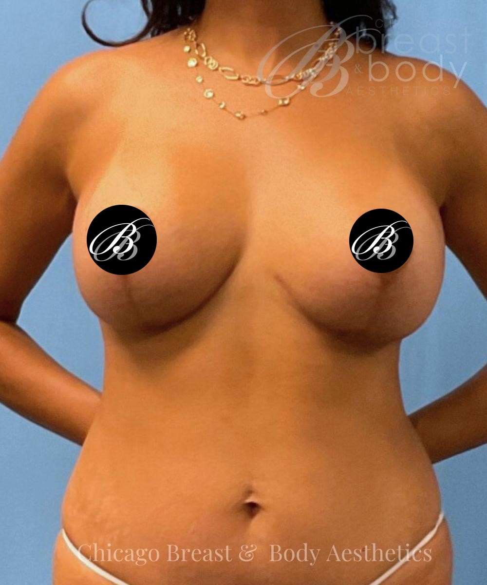 After breast lift with 350cc implants, front view, 3 months after surgery, case 1953743, patient of Dr. Kevin Lin