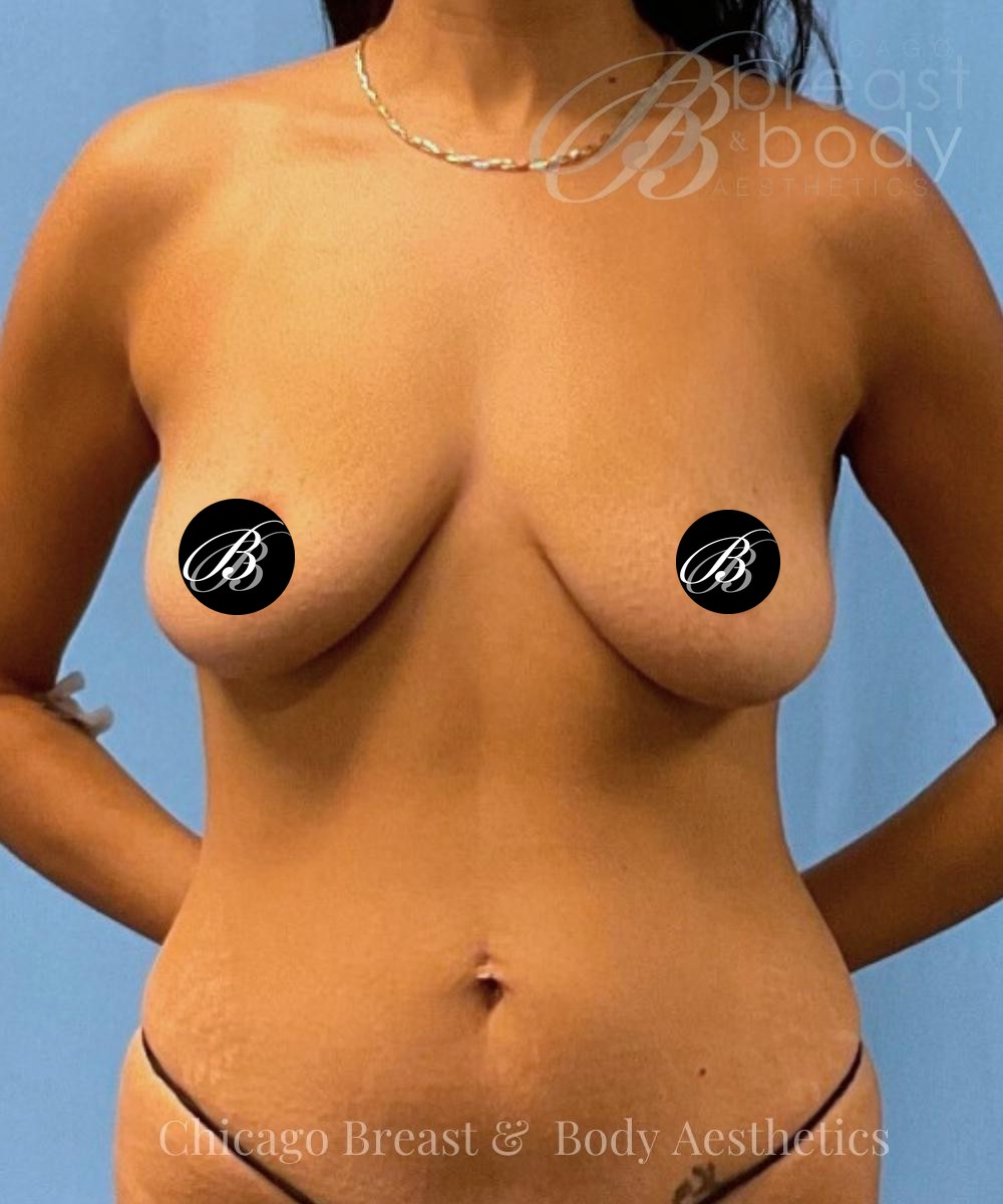 Before breast lift with 350cc implants, front view, case 1953743, patient of Dr. Kevin Lin