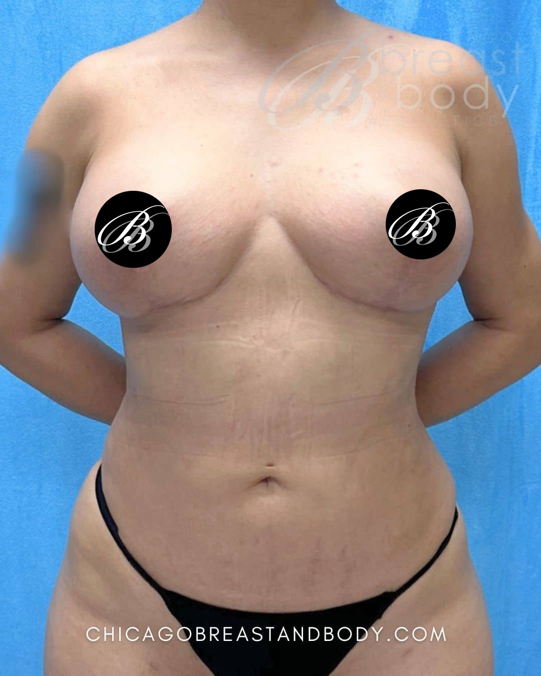 After photo of a breast lift with implants patient of Dr. Anh-Tuan Truong, case 1976787