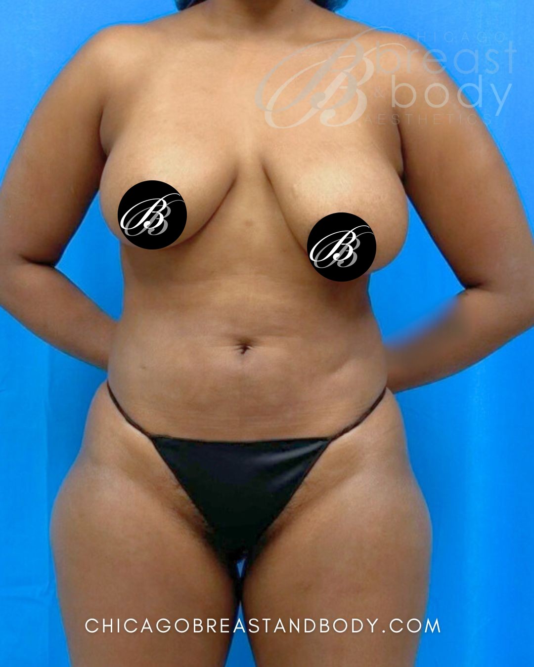 Before photo of a breast lift with implants patient of Dr. Anh-Tuan Truong